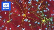 New gene therapy for Huntington's 'changes everything', say researchers