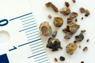 Deshazte de las piedras en los riñones de forma natural: 13 remedios caseros que sí funcionan