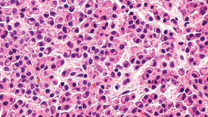 Especialistas advierten que Mieloma Múltiple sigue siendo diagnosticado tardíamente