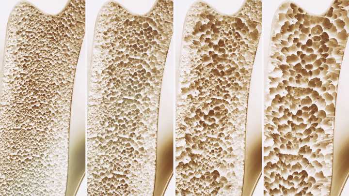 FDA Approves Fifth Set of Biosimilars of Prolia/Xgeva