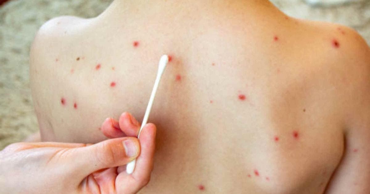 México enfrenta grave crisis de sarampión: Encabeza la mortalidad