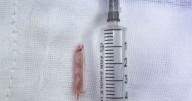 Doctors find thermometer that was lodged inside woman's bottom for 22 years