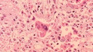 California child dies of rare measles complication years after infection