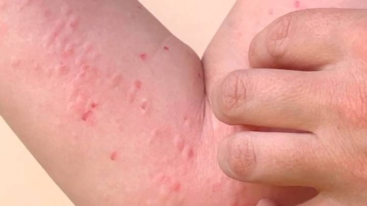 Vigila Coahuila casos de Mpox; reporta Salud Federal tres contagios