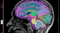 Woman claims Alzheimer’s symptoms were reversed after five years