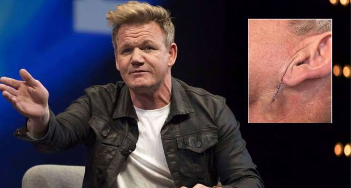 Gordon Ramsay Shares Surgery Scar as He Reveals Skin Cancer Diagnosis