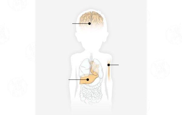 Esto es lo que la desnutrición le hace al cuerpo de los niños