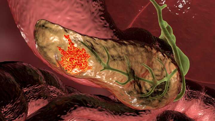 Exosome Biomarkers Can Distinguish Pancreatic Cancer from Benign Disease