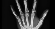 Korean 3D ‘glue gun’ prints custom bone repairs directly onto fractures
