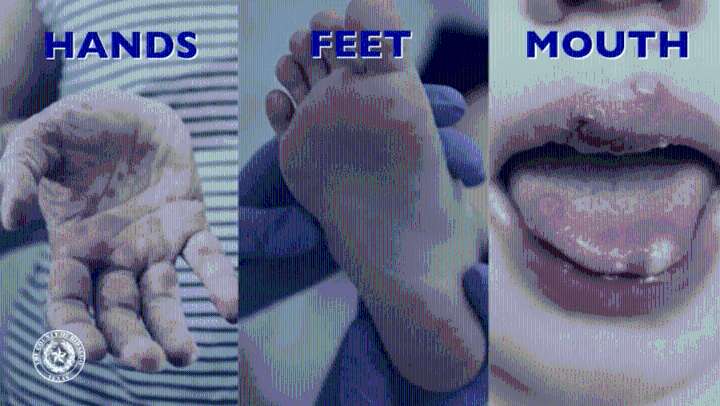 A closer look at the Hand, Foot, and Mouth Disease outbreak in Hidalgo County