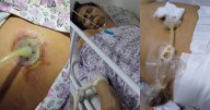 Hospital de Ibagué habría negado atención a adulta mayor con sonda infectada tras cirugía innecesaria
