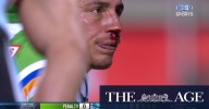 Raiders prop bleeds from high shot