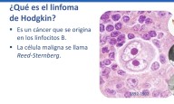 Linfoma de Hodgkin cáncer en la sangre que se manifiesta por crecimiento de ganglios 