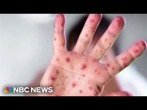 Los Angeles child dies of complications from measles virus