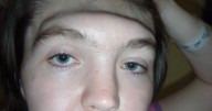 Woman shares incredible transformation after losing entire forehead in freak accident