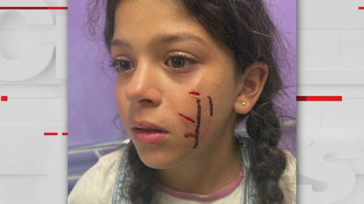 9-year-old girl allegedly mauled by an off-leash dog at a Toronto park