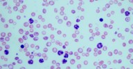 En 2026 se diagnosticarán 28.000 nuevos casos de cáncer sanguíneo en España