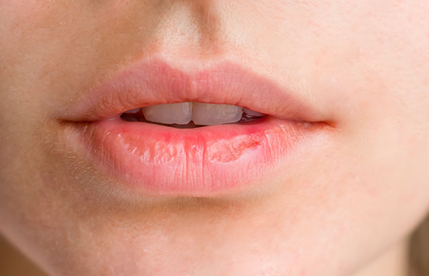 Un nuevo antiviral contra el herpes simple doblega la resistencia a los tratamientos