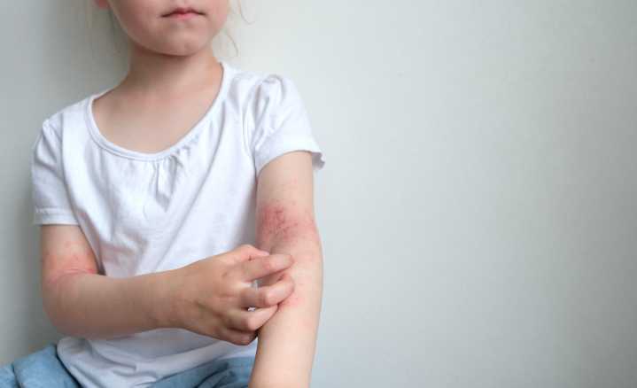 FDA Expands Approval of Opzelura Cream to Children Ages 2 to 11 with Atopic Dermatitis