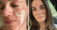 Mujer denuncia a esteticista de celebridades por daños: “Pensé que era crema y era mi piel quemada”