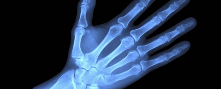 Microplastics Found Deep Inside Human Bones, Scientists Warn