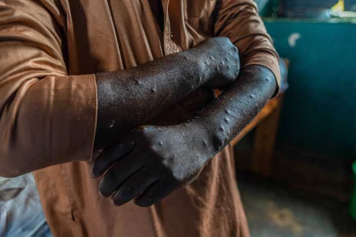 Whatever happened to mpox? Is it still a threat?
