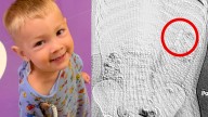 Boerne toddler undergoes emergency surgery after swallowing magnets
