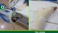En Rionegro, un joven lleva 27 días esperando una cirugía para salvar su pie: Eps no autoriza