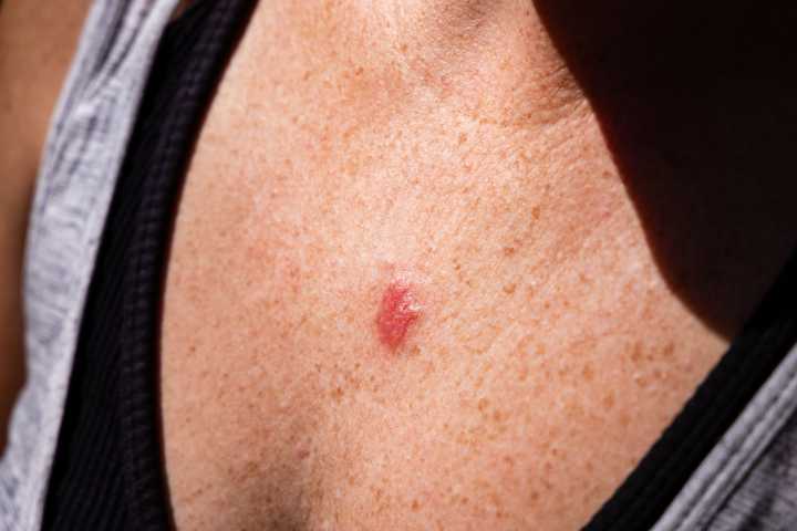 Microneedle Cancer Treatment Earns FDA Meeting