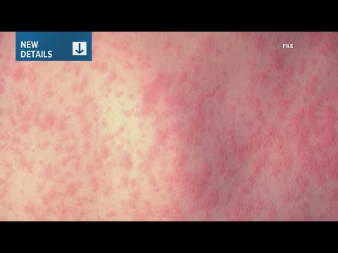 3 new measles cases confirmed in Georgia, health officials say