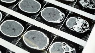 La UE aprueba un fármaco de nueva generación para el tratamiento del Alzheimer
