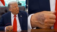 ¿Qué revela la mancha oscura en la mano de Trump sobre su salud?
