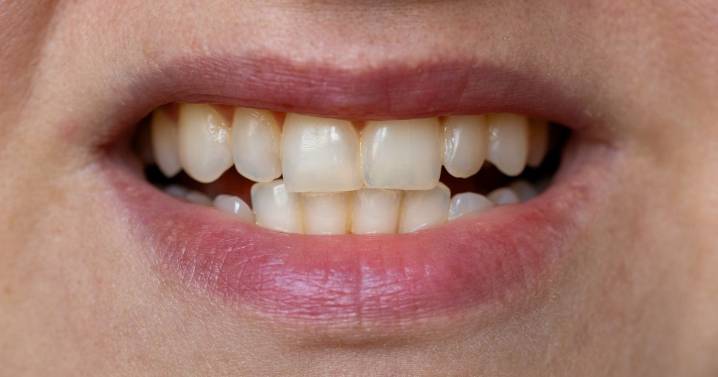 What colour of your teeth really means - from liver disease to fluorosis