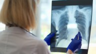 La tuberculosis reapece con fuerza en País Vasco y Cataluña