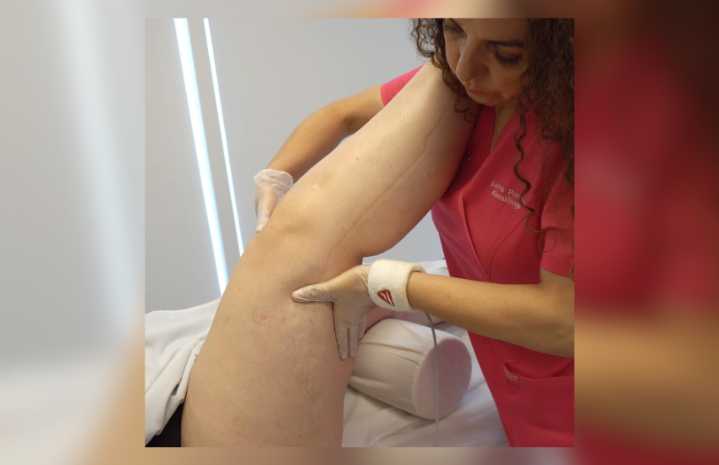 Lipedema en Chile: lanzan primera encuesta para tener catastro de pacientes e impulsar avances