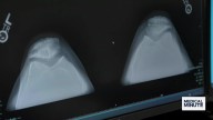 Health experts share ways to manage knee pain without surgery
