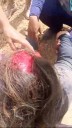 Se “desprendió” el cuero cabelludo tras caerse de su moto