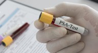 Mientras disminuyen pruebas de antígeno: tasas de cáncer de próstata aumentan anualmente en EE.UU.