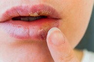 ¿Sabías que las infecciones de transmisión sexual pueden manifestarse en tu boca?