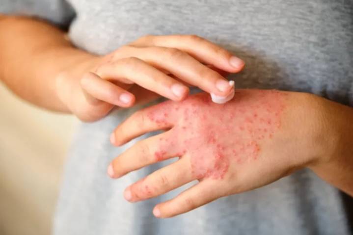 Día Mundial de la Dermatitis Atópica: causas y tratamientos