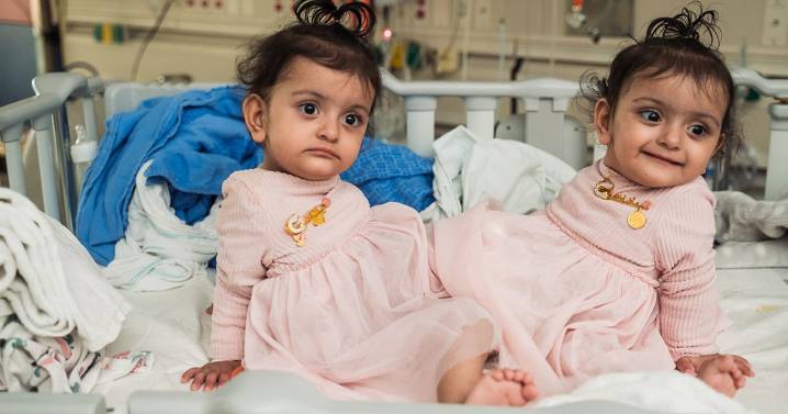 15-Month-Old Conjoined Twins Successfully Separated After 18