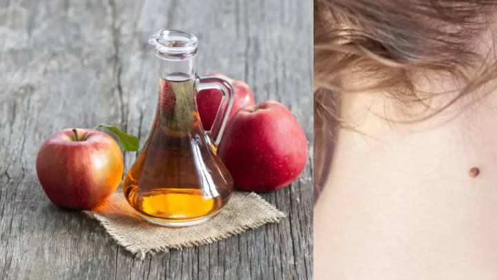 ¿Se puede usar vinagre de manzana para quitar verrugas en la piel? Estos son los riegos que conlleva