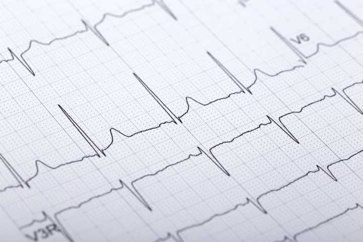 Deep Learning Approach Shows Promise for Automatic Assessment of Schizophrenia Using Wearable Technology