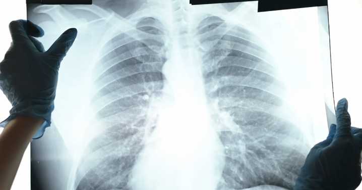 Caboolture Hospital: Queensland Health in damage control over radiology reports bungle