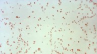Sexually transmitted disease cases fall, but not syphilis in newborns