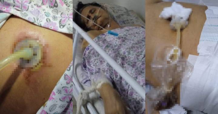 Hospital de Ibagué habría negado atención a adulta mayor con sonda infectada tras cirugía innecesaria