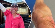 NSW uni student's arm 'torched' after phone charger explodes