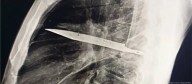 Hombre vive 8 años con un cuchillo en el tórax sin saberlo