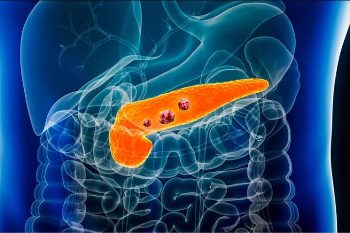 Descubrieron 27 bacterias y hongos que triplican el riesgo de cáncer de páncreas