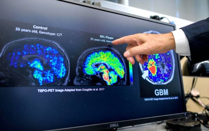 Científicos latinos en EEUU hallan biomarcador que podría detectar temprano el Alzheimer